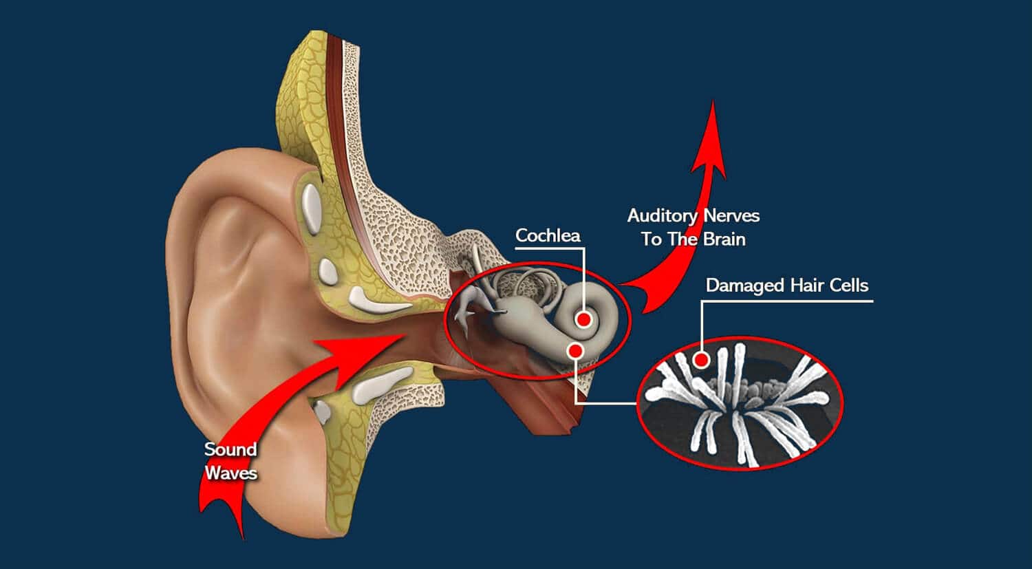 ARHL AND NIHL figure