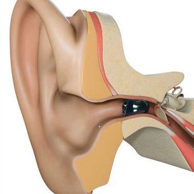 IIC Hearing Aids